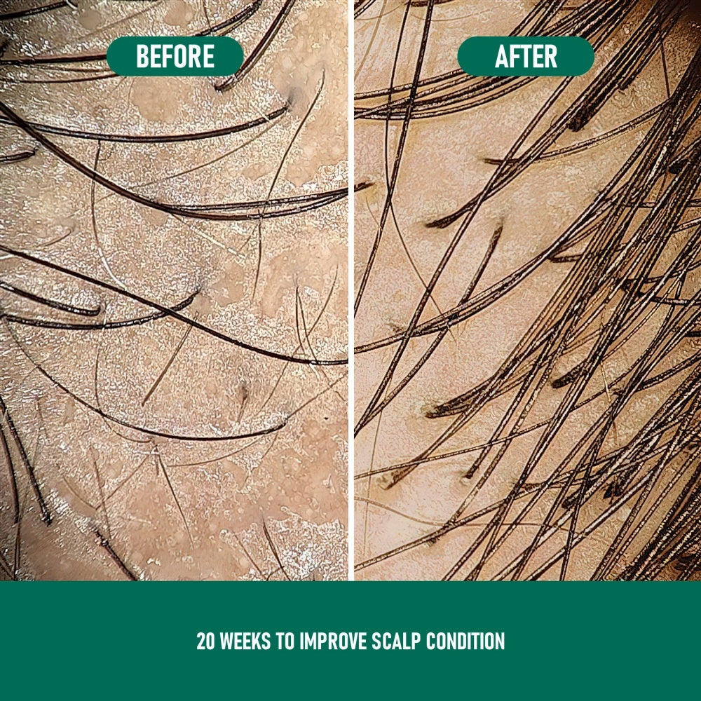 CH004 Minoxidil Anti-Hair Loss Mousse - Bests Sale