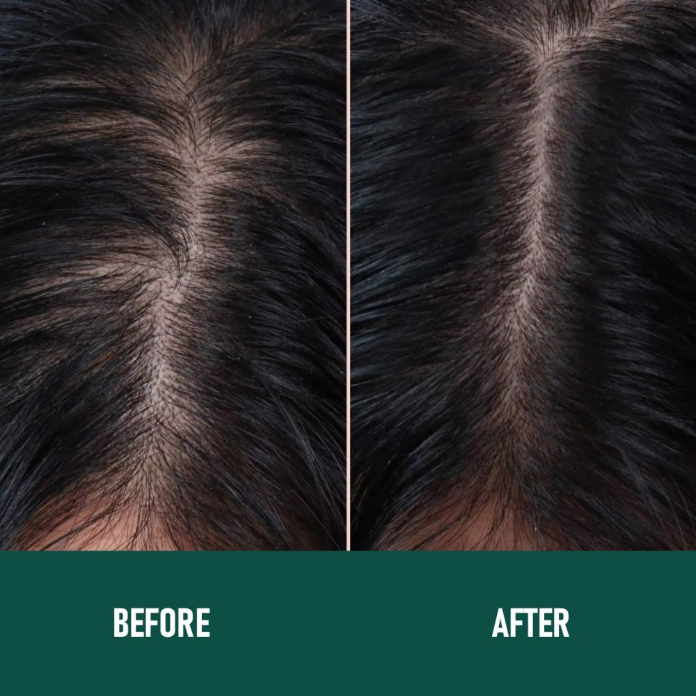 CH004 Minoxidil Anti-Hair Loss Mousse - Bests Sale
