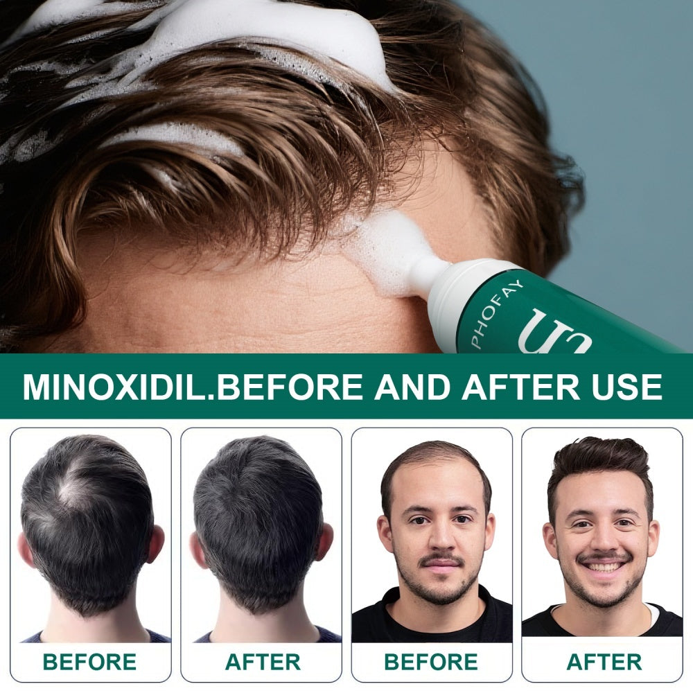 CH004 Minoxidil Anti-Hair Loss Mousse - Bests Sale